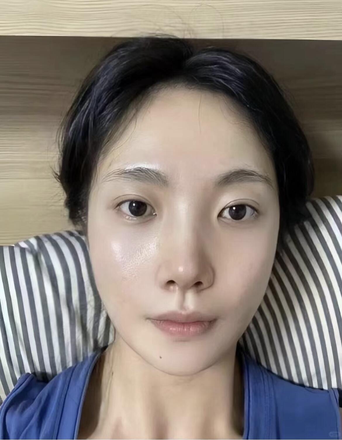 便踏入了美容整形的大门几乎每两个月就会安排一次光子嫩肤和水光针