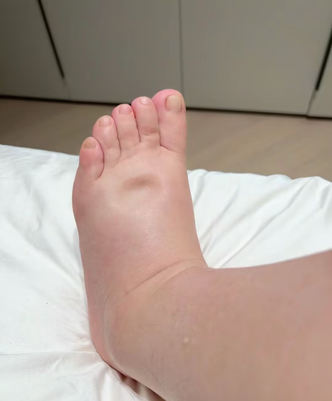 腿部水肿: 脚踝或小腿部位肿胀,这时候可能由于肝功能受损无法正常