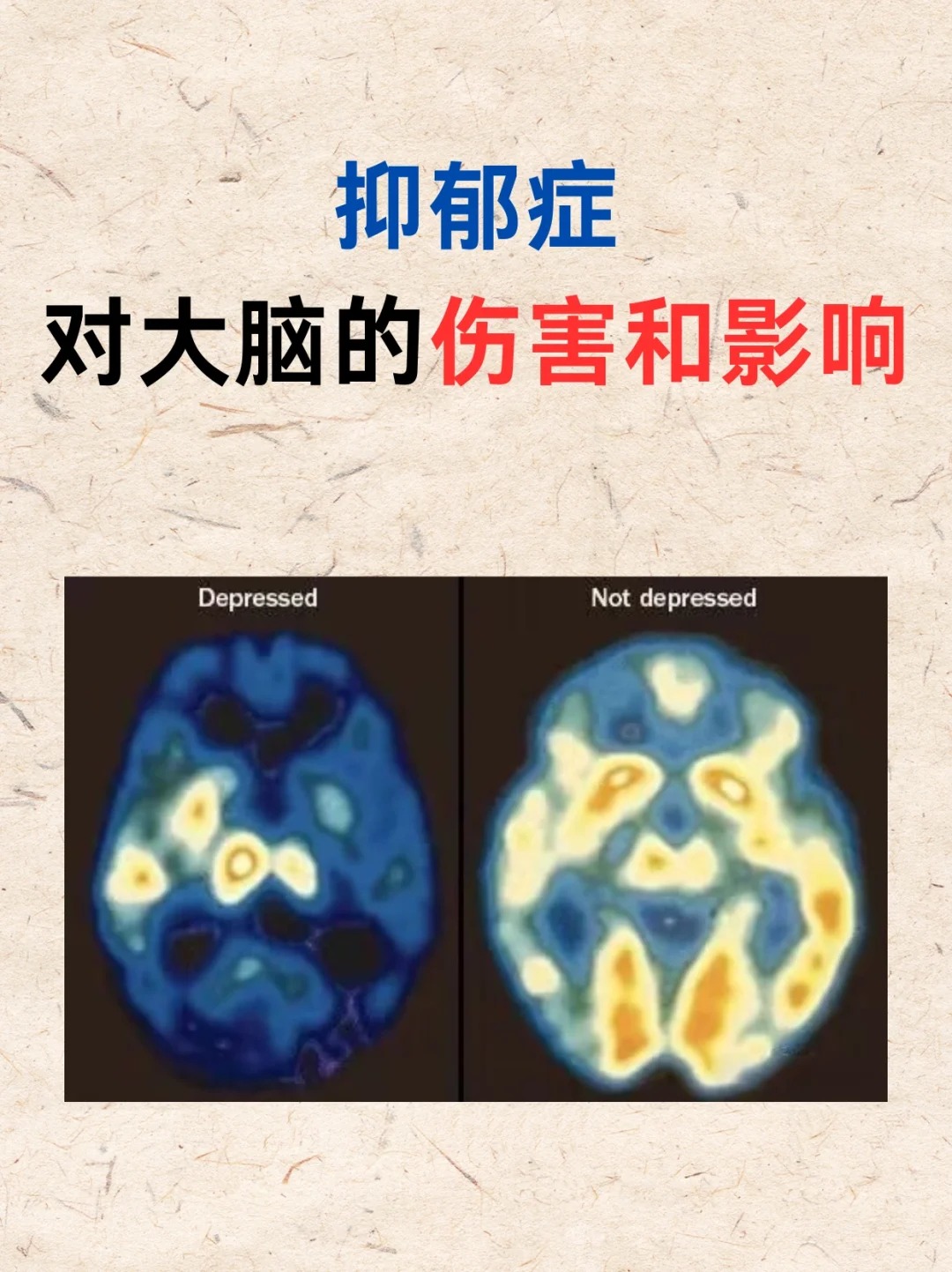 大脑神经递质水平失衡 2