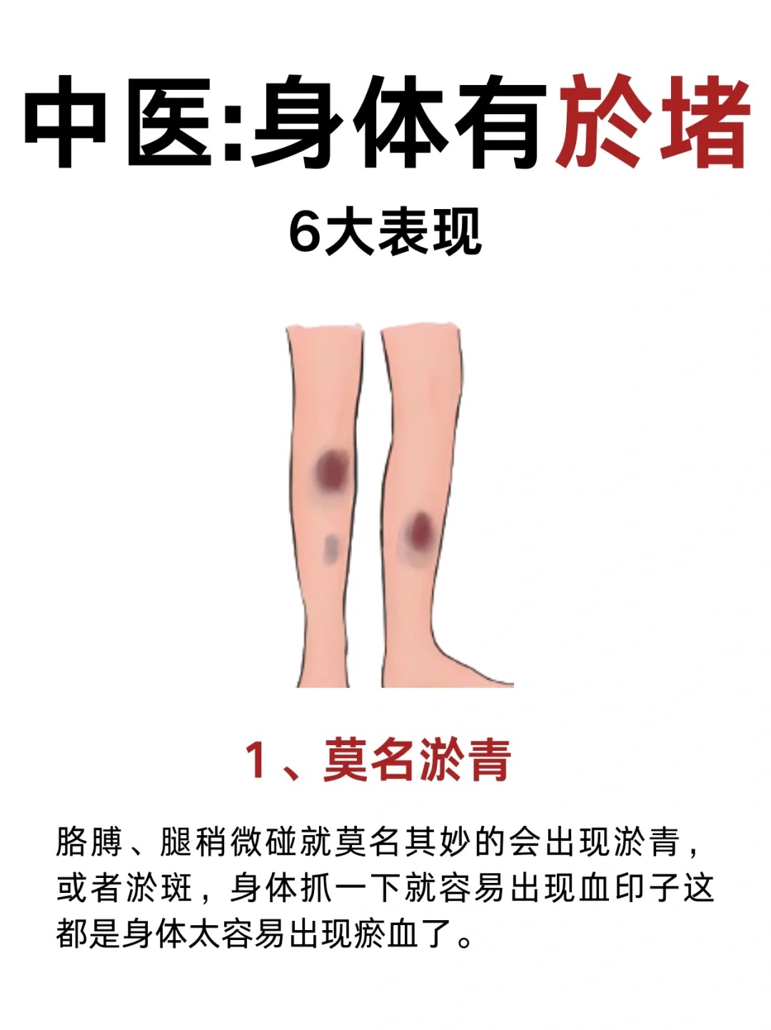 中医:瘀血,身体健康的头号杀手 1,莫名淤青 2,月经有血块 3,看舌头 4