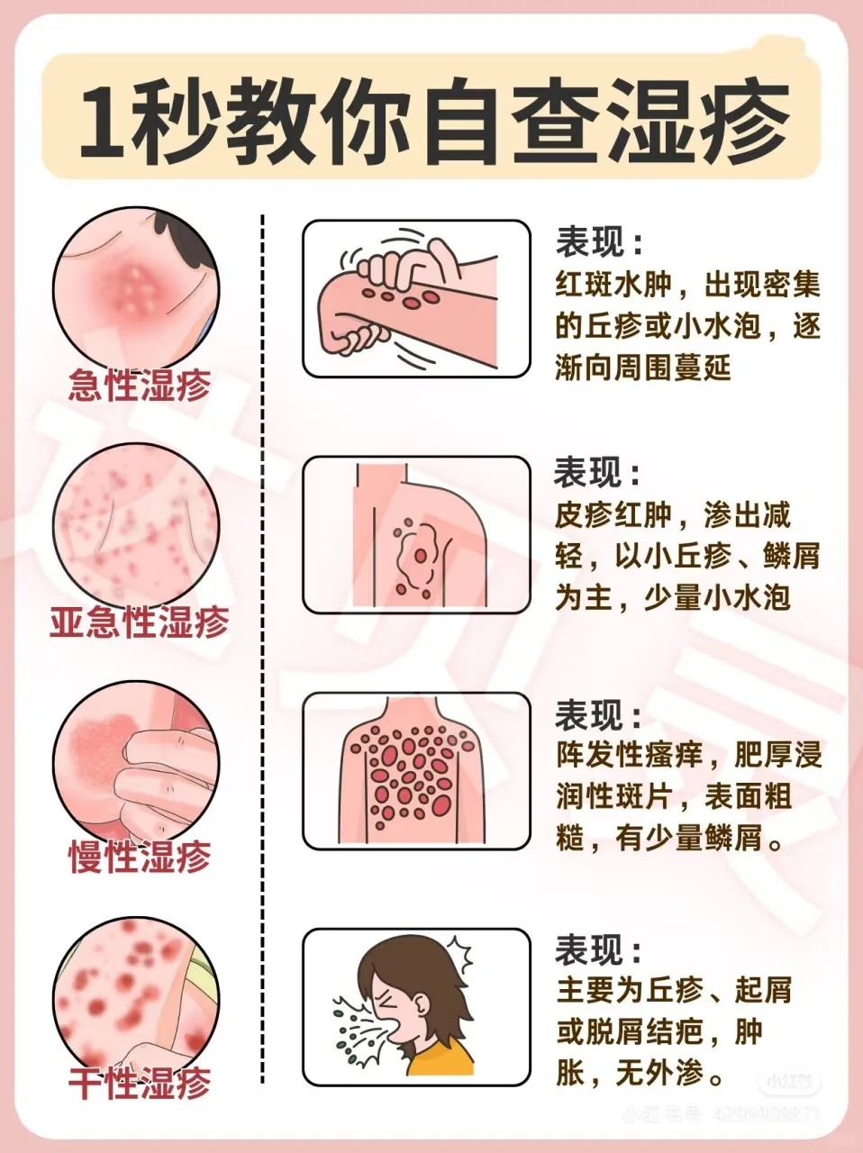 1,加强皮肤护理: 患者平时一定要保持皮肤清洁,但避免过度清洗,翔澡