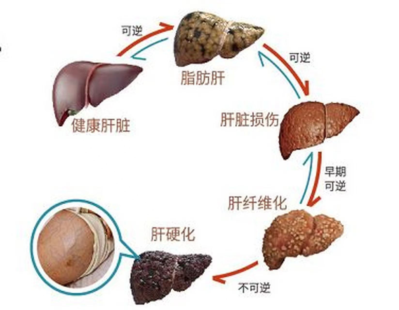 肝硬化想要逆转,这5点必不可少!