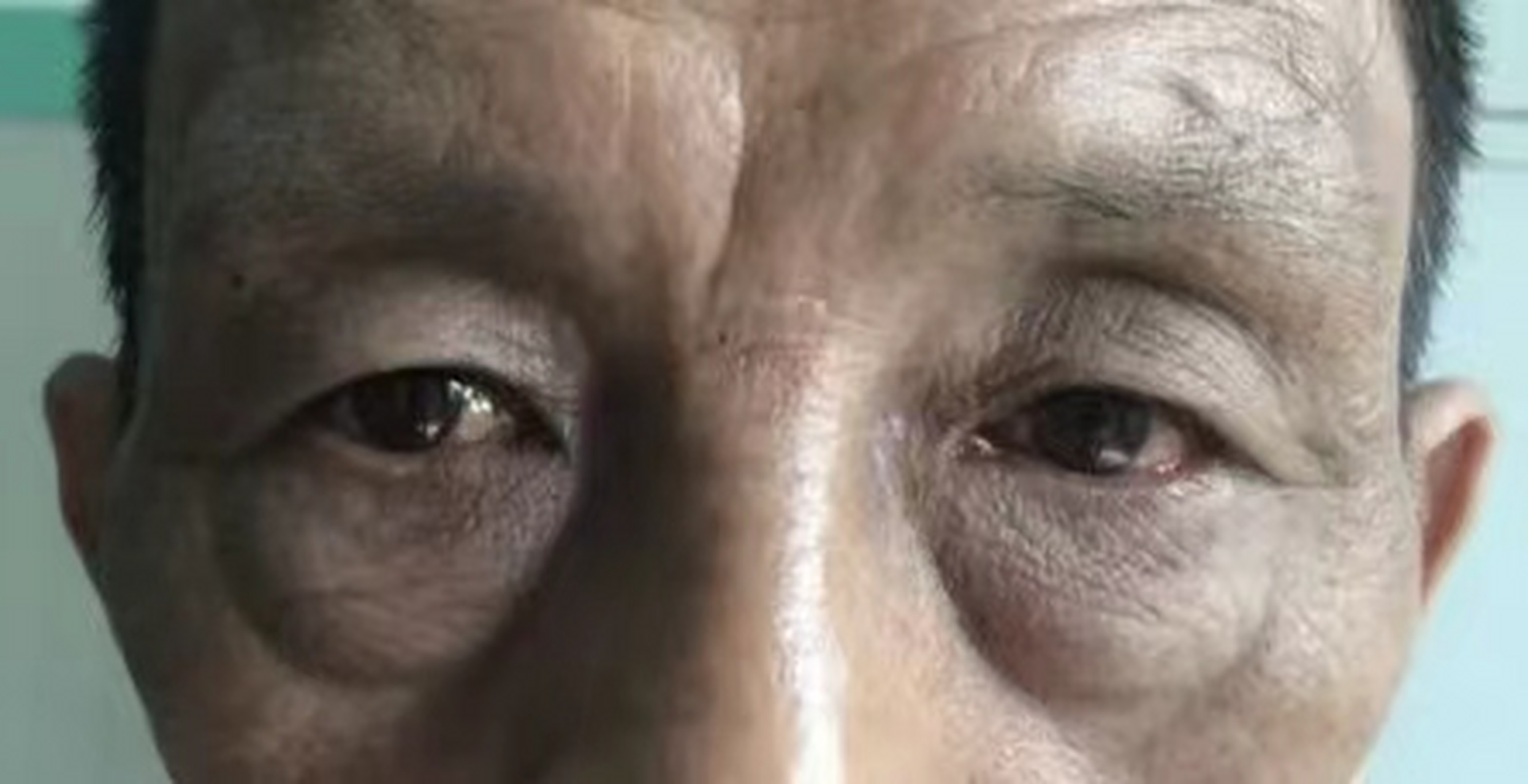 肝硬化患者要注意,这5个症状可能是肝腹水的信号!