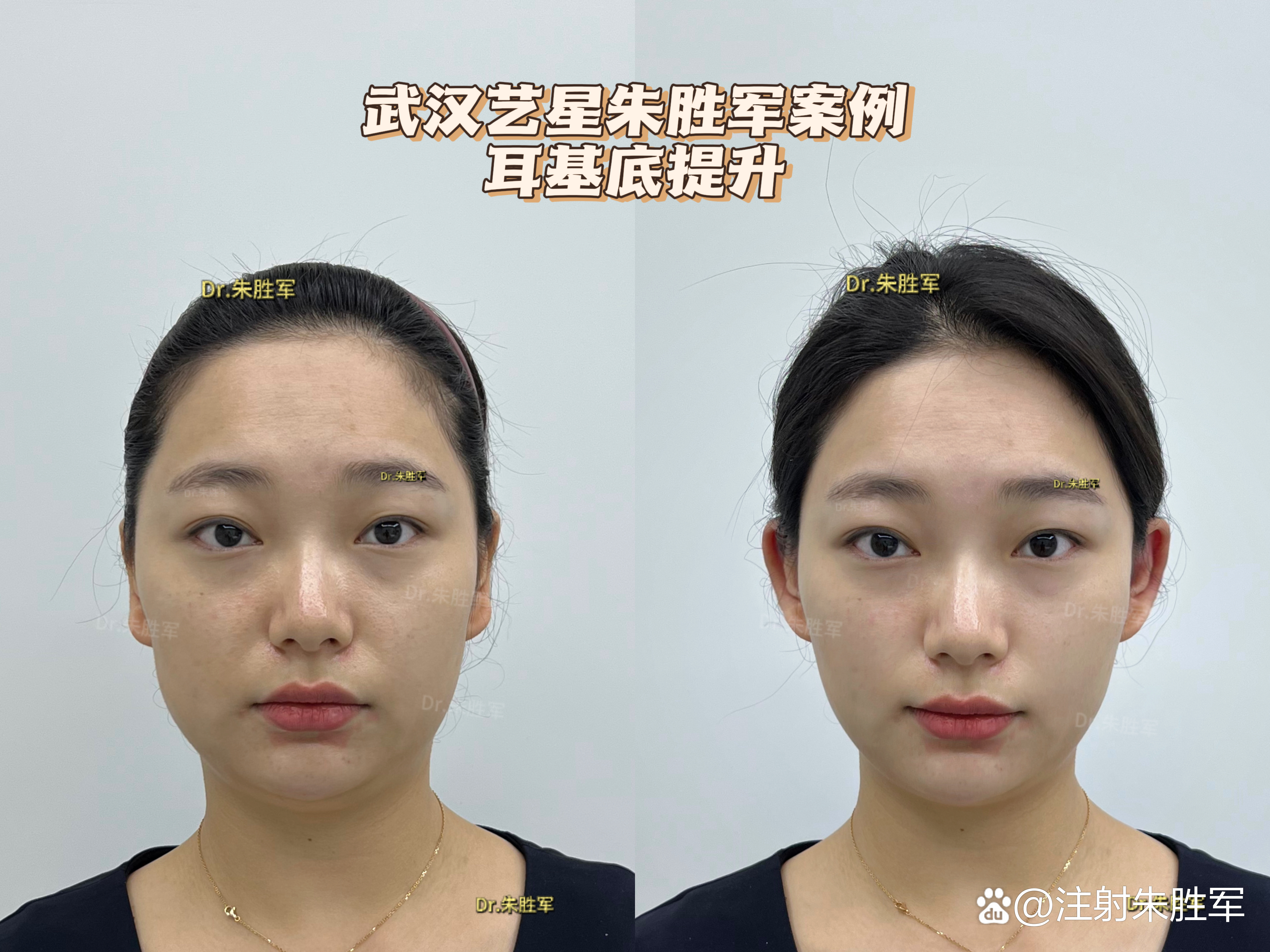 外轮廓流畅是精致感的第一步 内外轮廓固定 颅顶增高 耳基底注射 塑造
