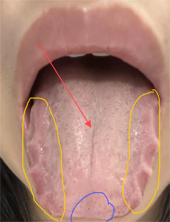 积食消化不良舌头图片图片