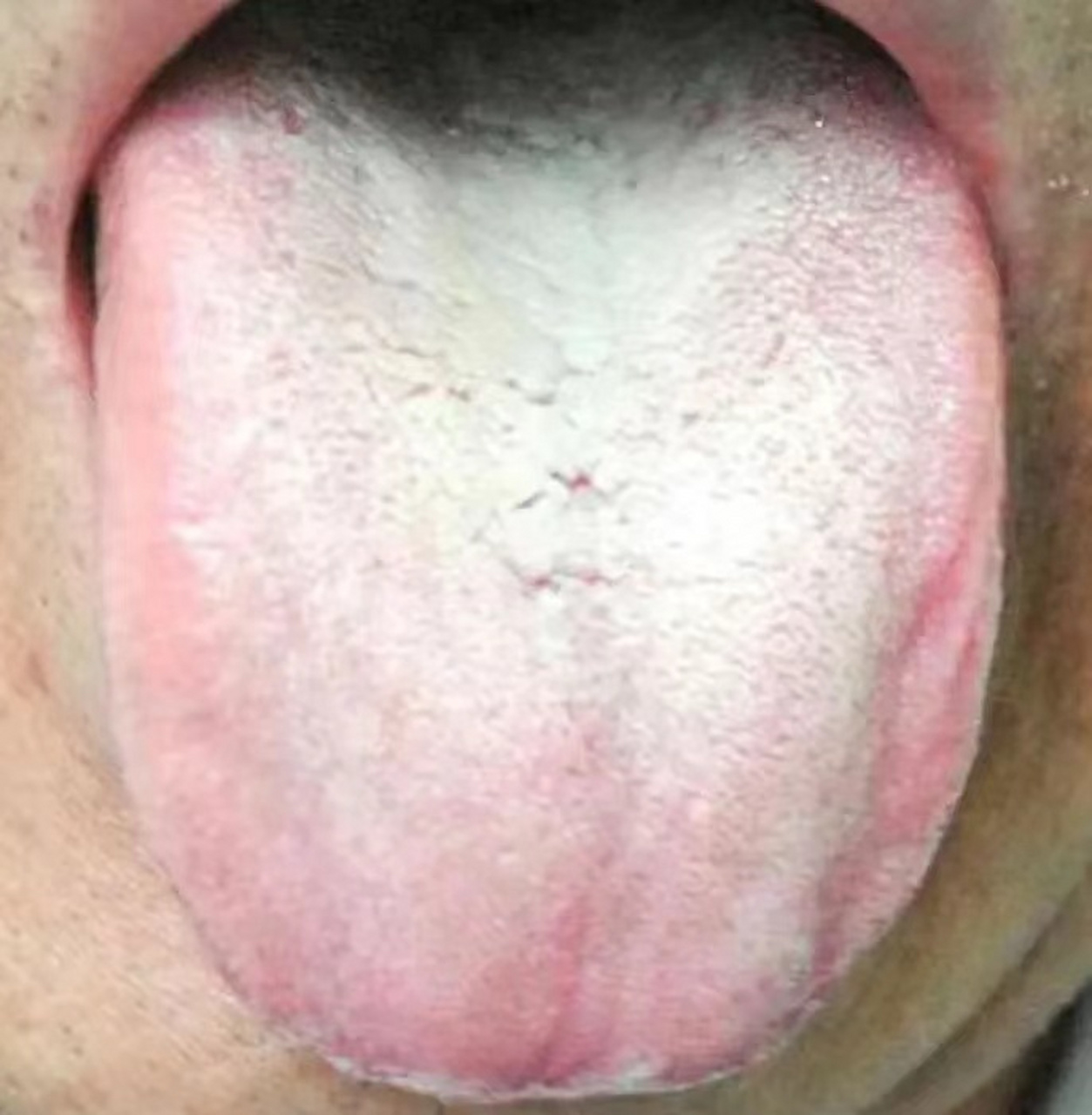 舌苔厚腻,说明痰湿重.但为何用经典的祛湿化痰方无效?