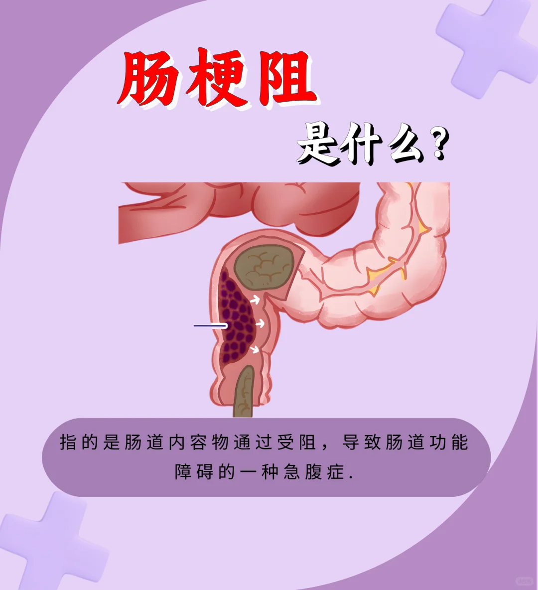 剖腹产肠梗阻是因为什么原因引起的为什么在线