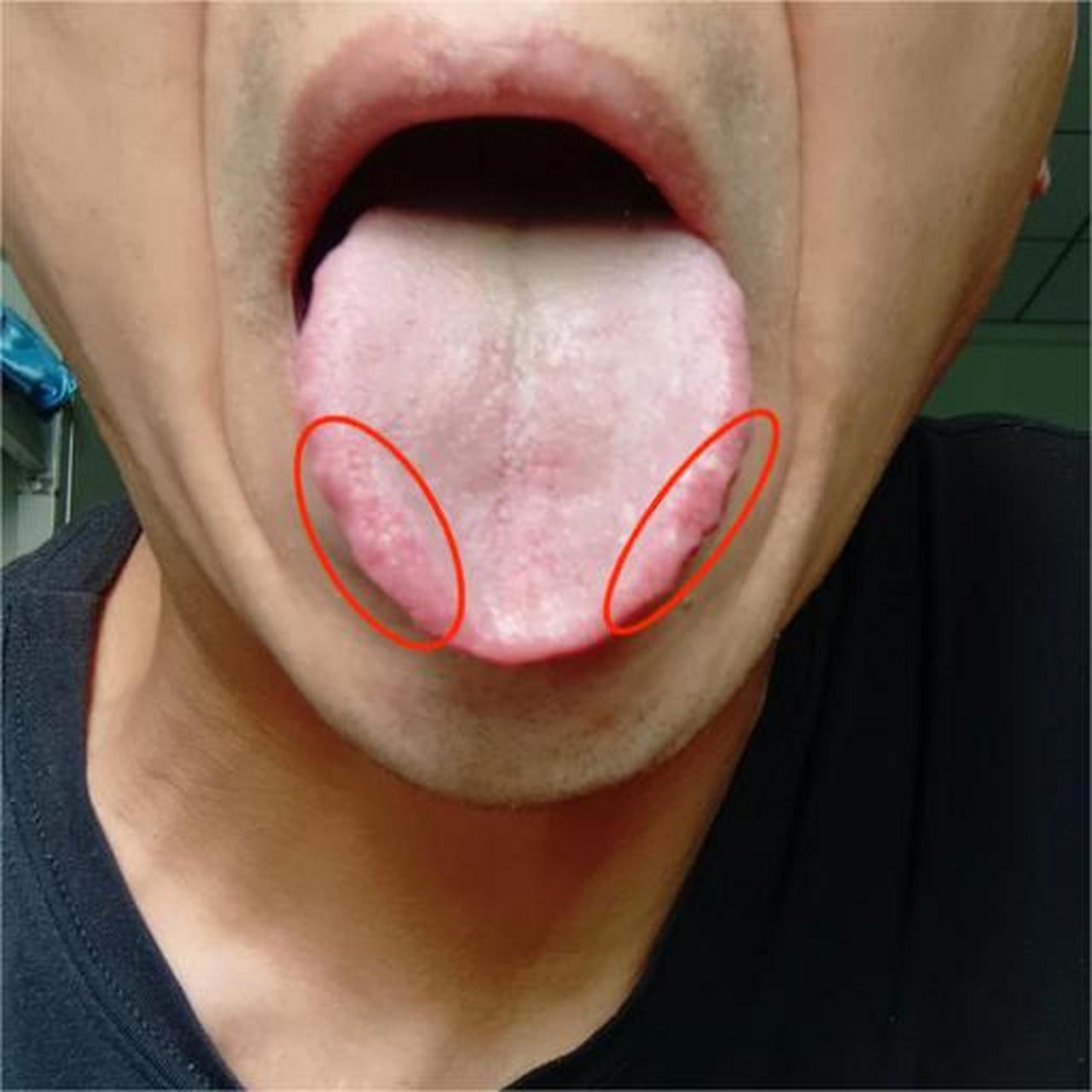 舌边上有齿痕,不能只看是不是脾虚了,这样的舌象现在经常遇到[祈福]