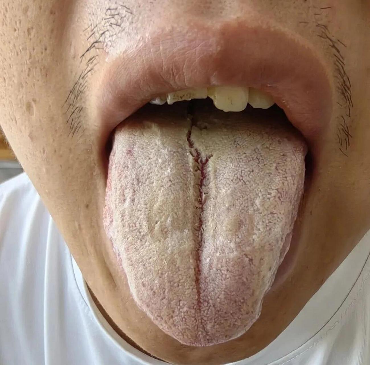 如果舌苔水滑,基本上就是寒湿,如果苔白,腻的结实,比较干,大多数是