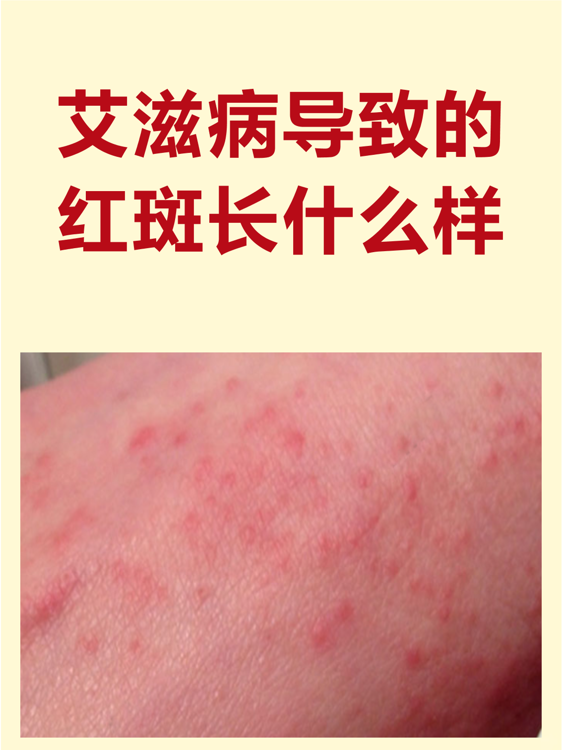 的皮肤红斑往往是免疫系统受损的信号,这种红斑与普通皮疹有明显区别