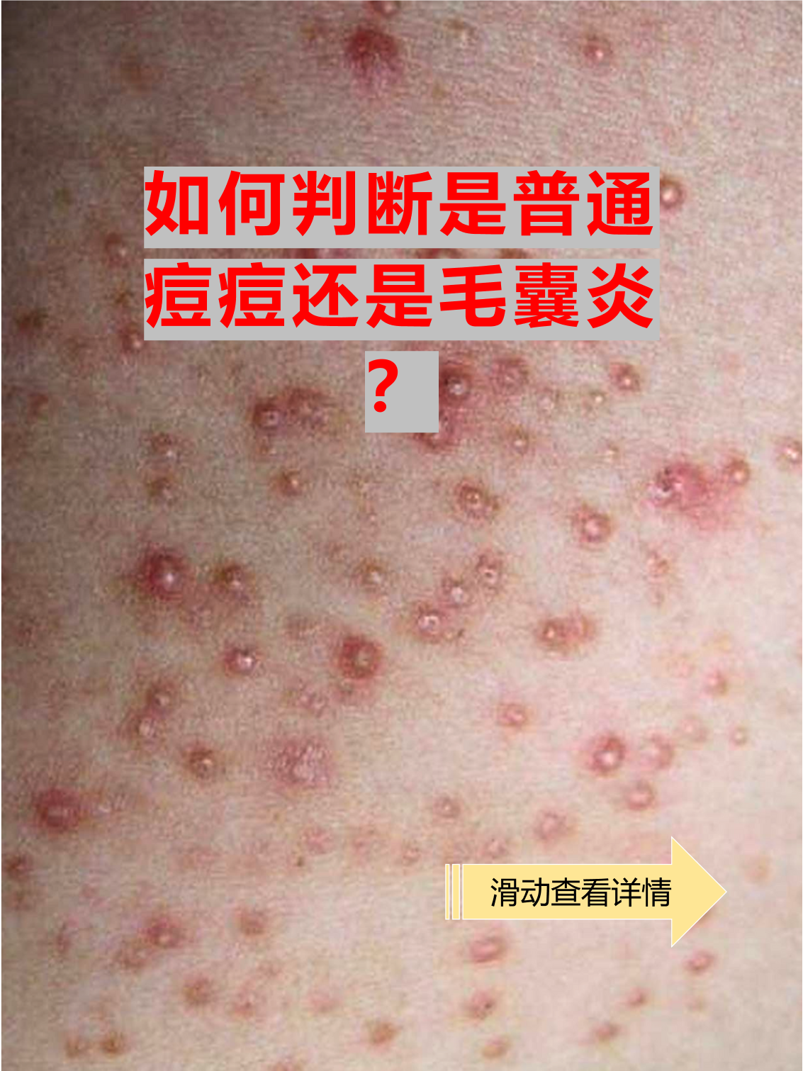 夏天脸上冒出小红疙瘩,很多人分不清是普通痘痘还是毛囊炎