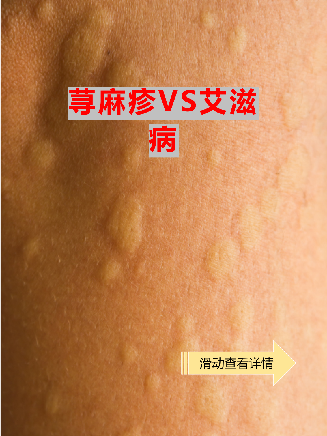 每当皮肤突然出现大片红疹,很多人会因恐慌而联想到