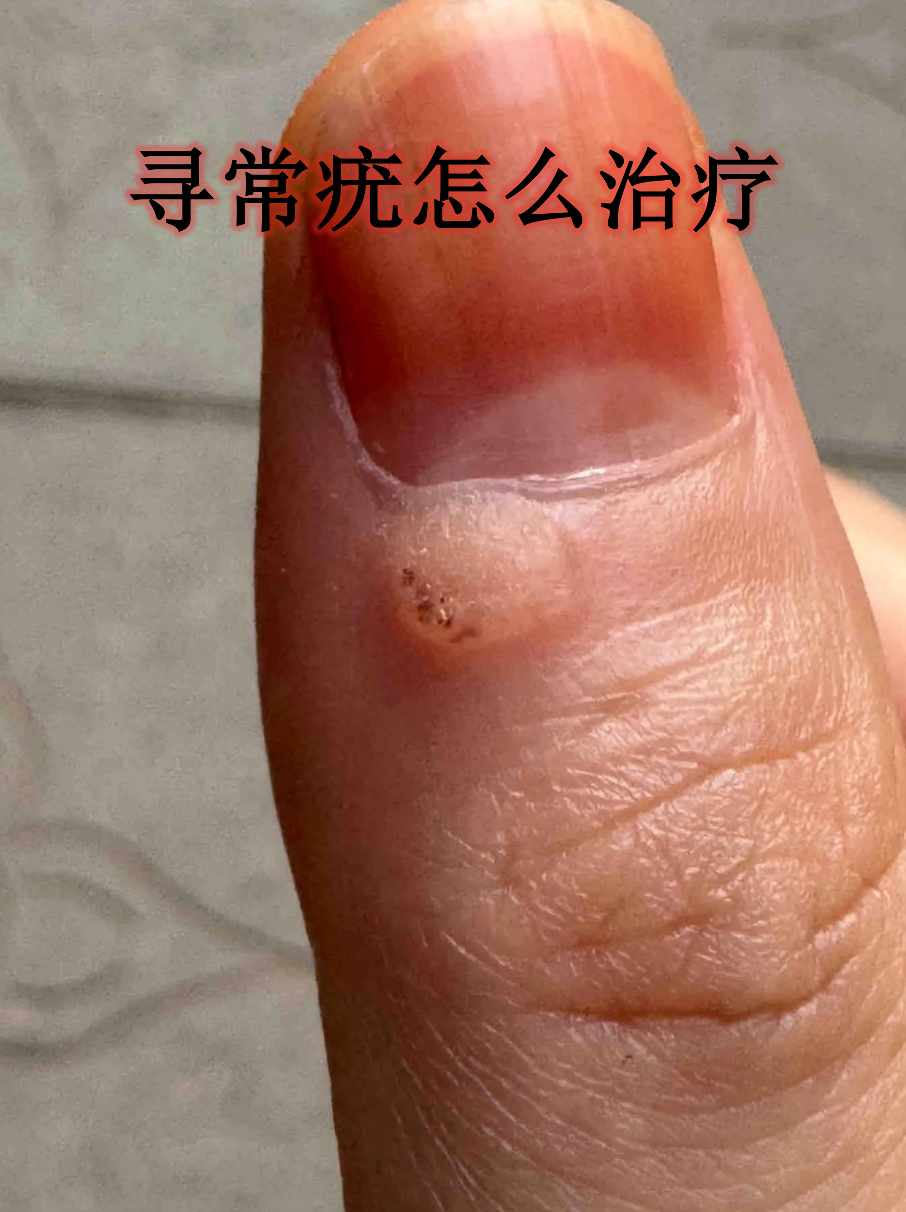 寻常疣俗称"刺瘊",是由人类乳头瘤病毒感染引起的皮肤良性增生,虽然