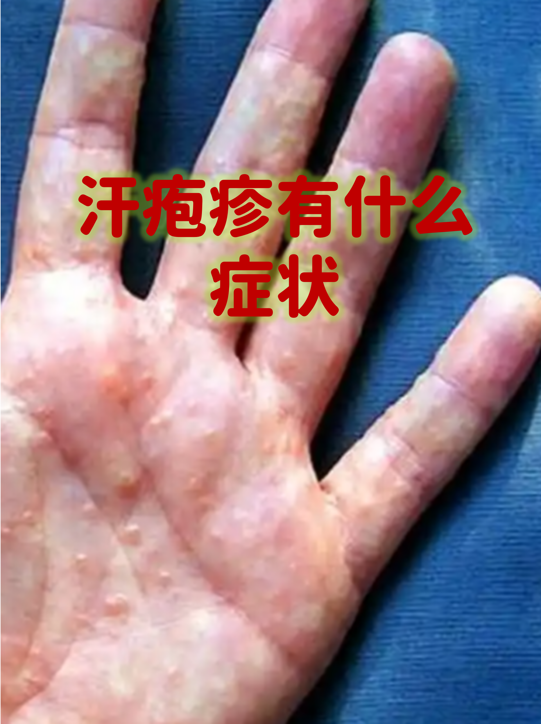 这可能是汗疱疹在作怪