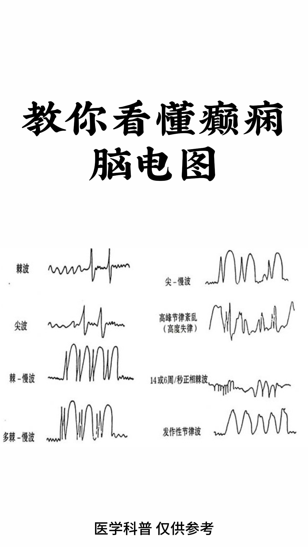 教你看懂癫痫的脑电图