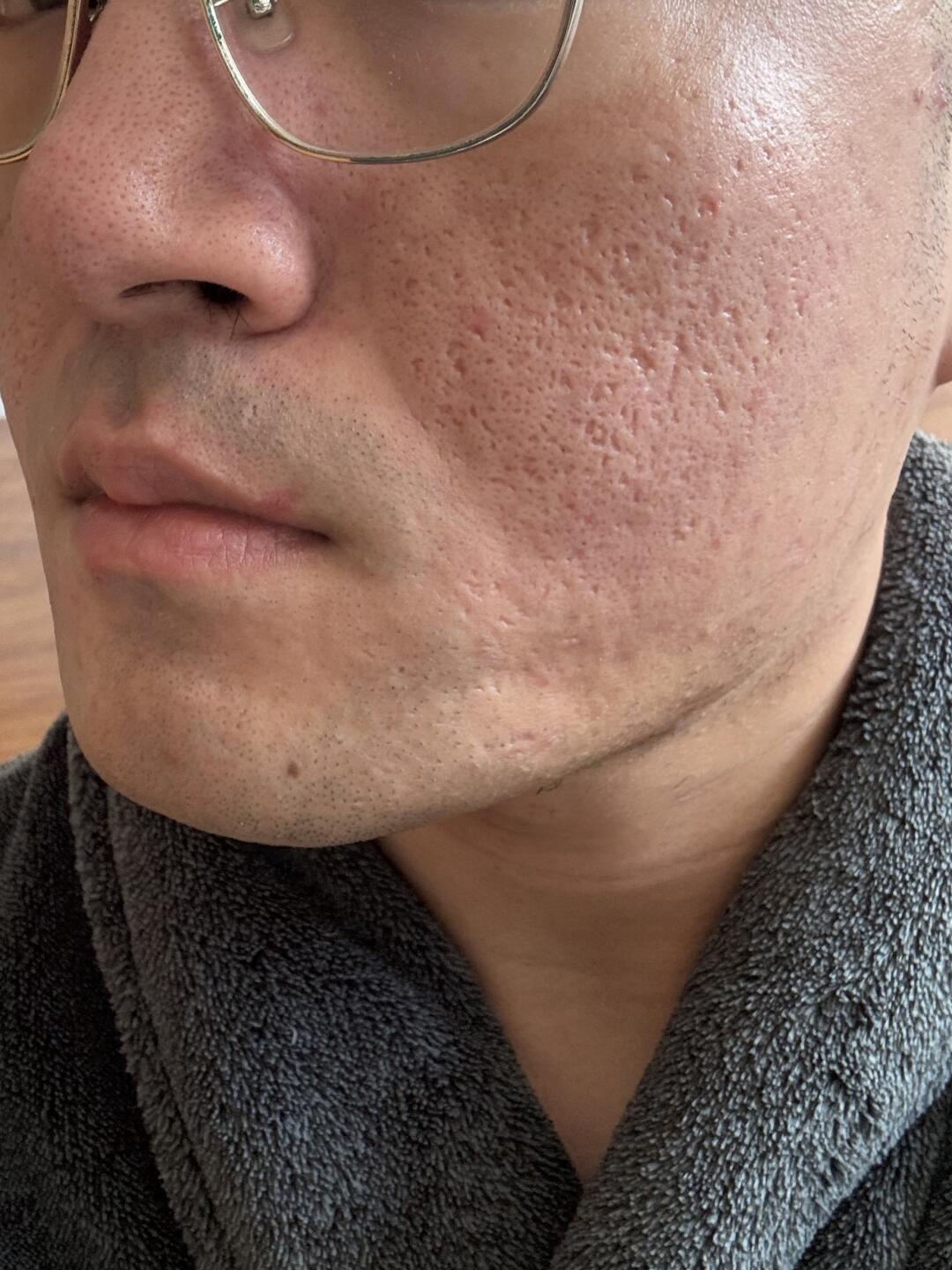 每天一个健康小技巧~ 很多姐妹问小助理痘坑几次能平