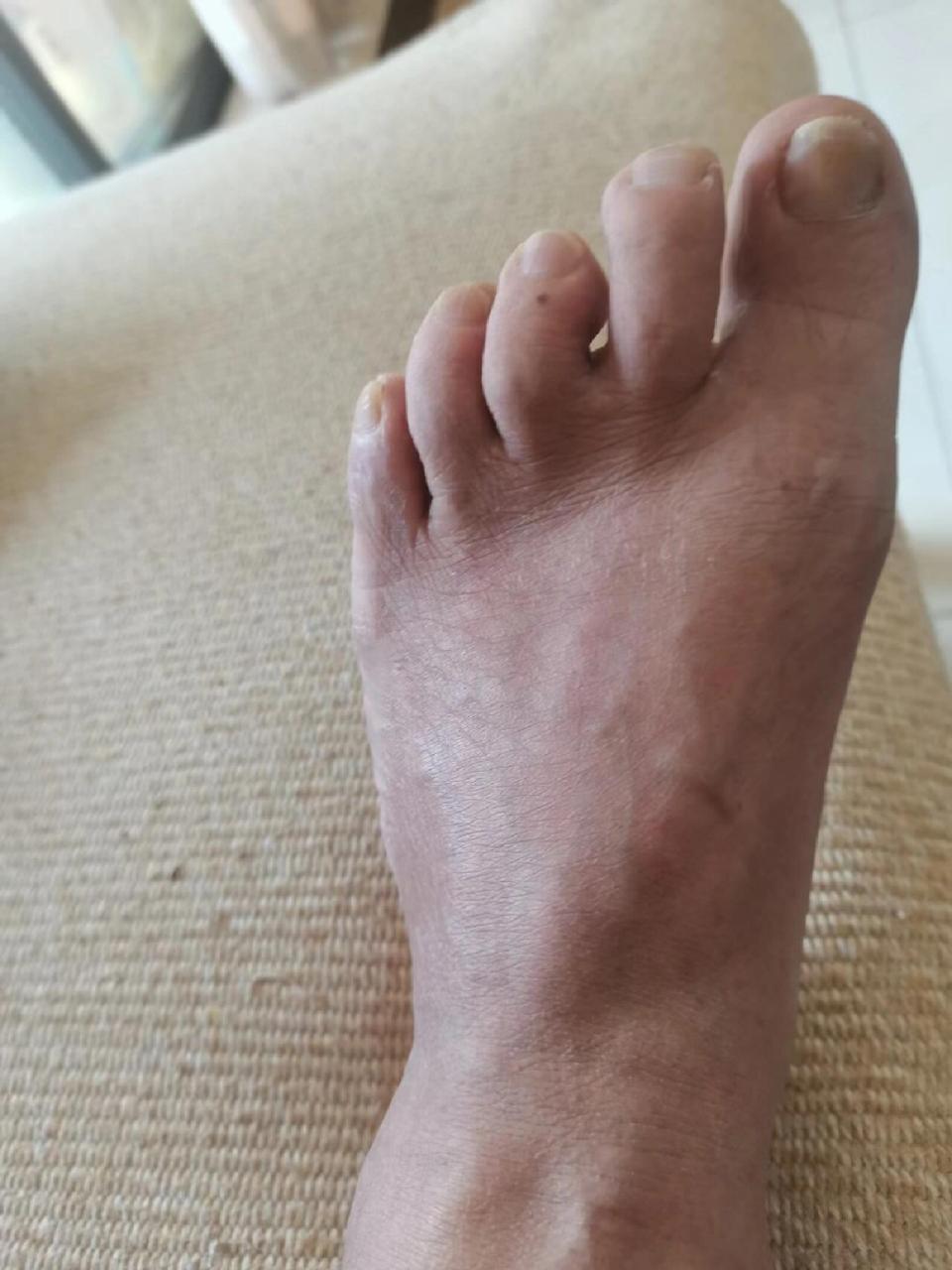 有没有同款痛风的  治疗前后对比结果,三天缓解疼痛,不要等痛到脚不能