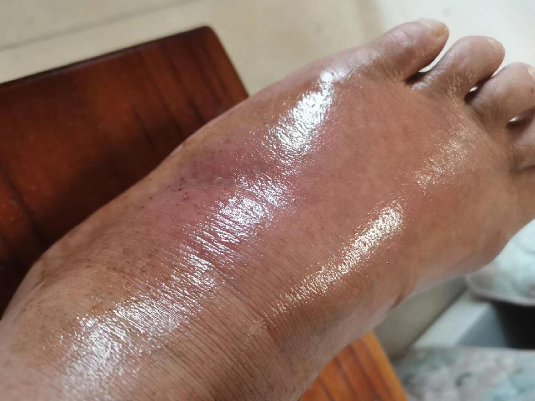 有没有同款痛风的  治疗前后对比结果,三天缓解疼痛,不要等痛到脚不能