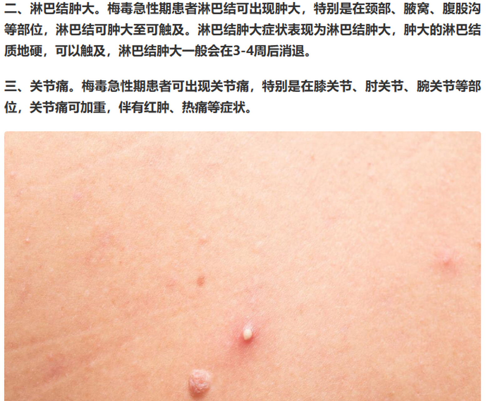 梅毒的急性期是病毒感染后的第一阶段,典型的临床表现主要有四类:  一