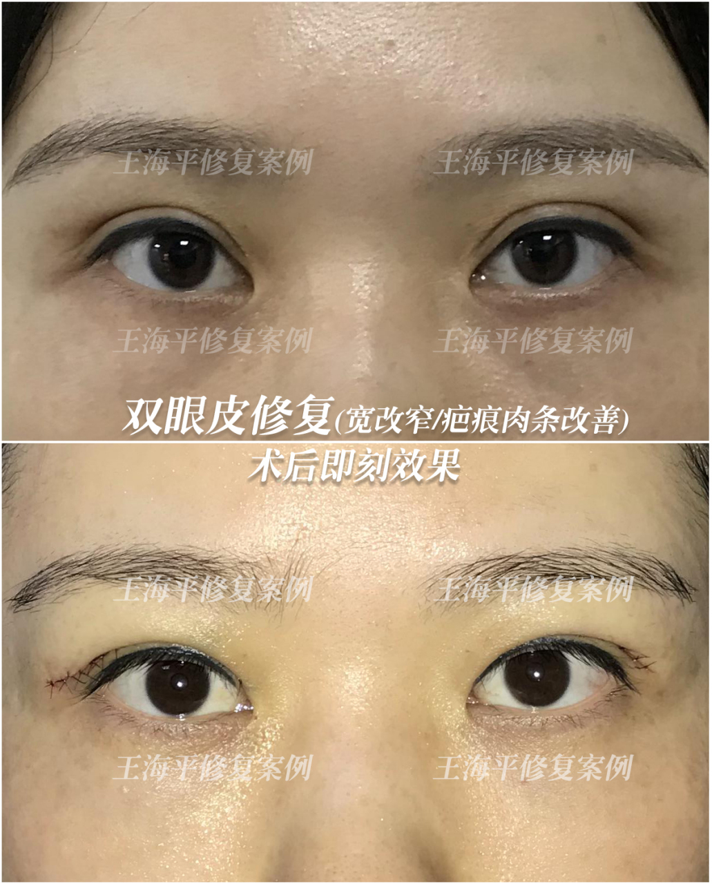 王海平# #武汉双眼皮修复# #双眼皮修复