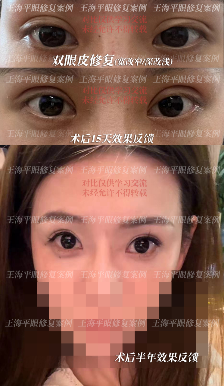 王海平# #王海平眼修复# #武汉双眼皮修复# #双眼皮修复