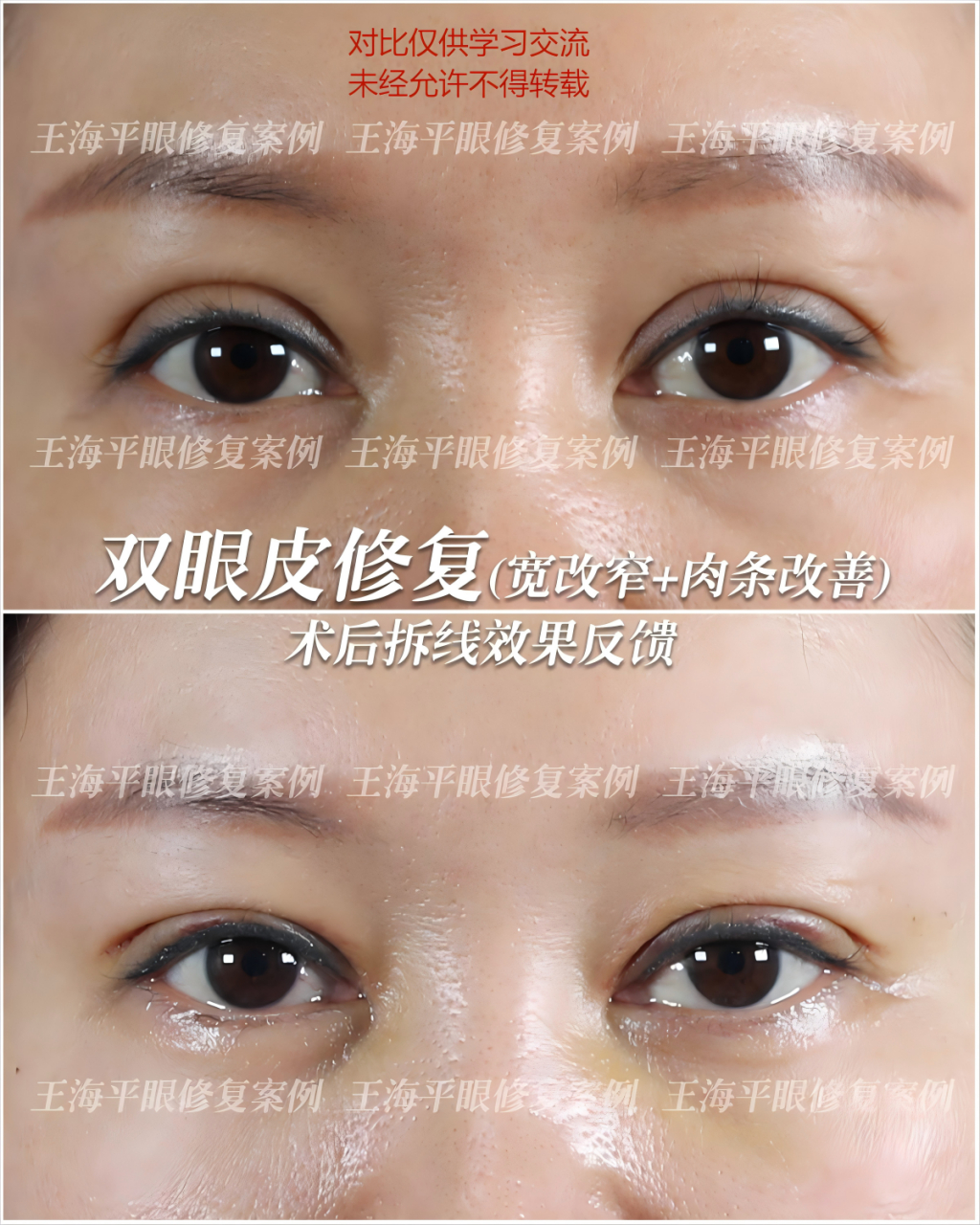 王海平# #武汉双眼皮修复# #双眼皮修复