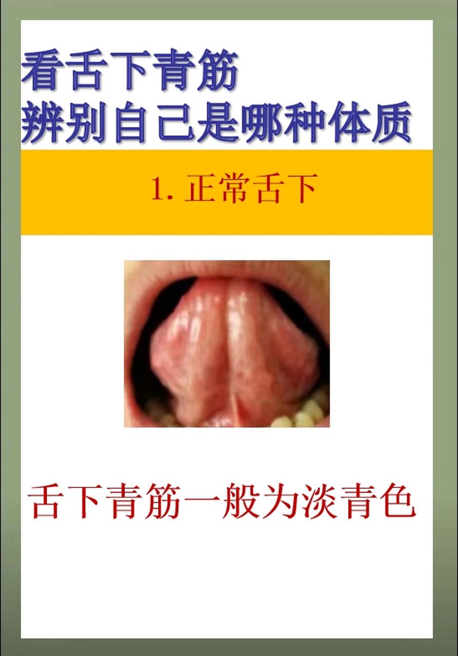正常舌下——舌下青筋一般为淡青色  2.