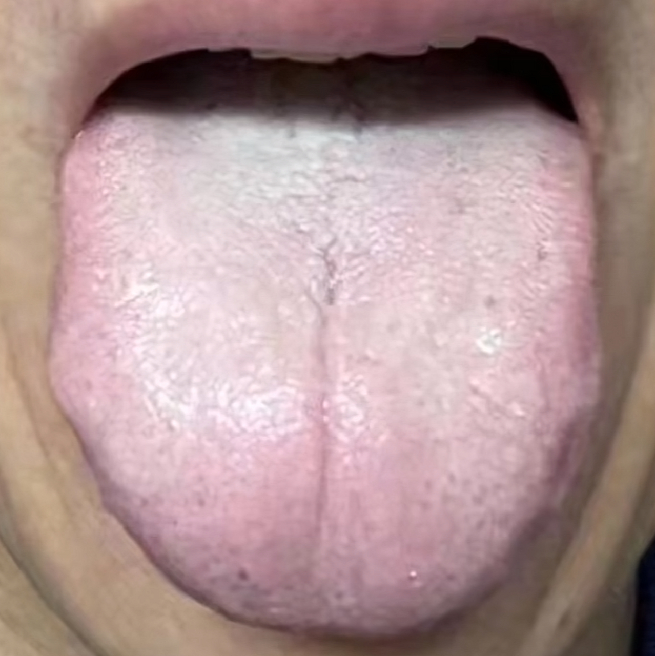 胖大以及有齿痕是因为脾虚,中间有裂纹常见于阴虚