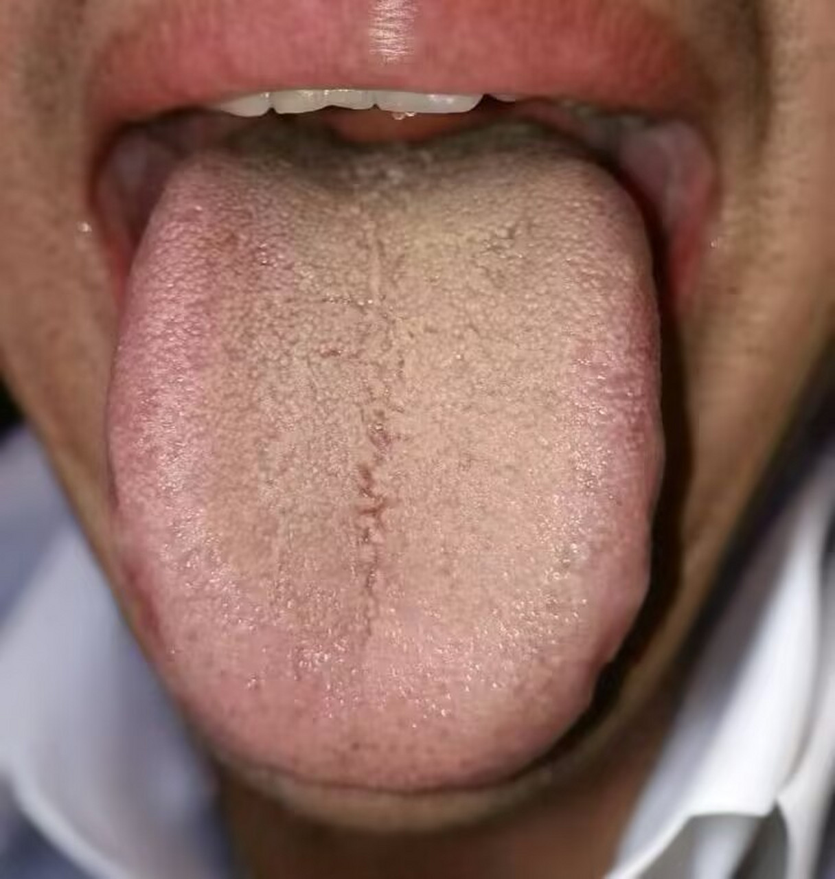 这个舌头,有裂纹,黄腻苔,典型的脾虚湿热表现,调理应该这样做!