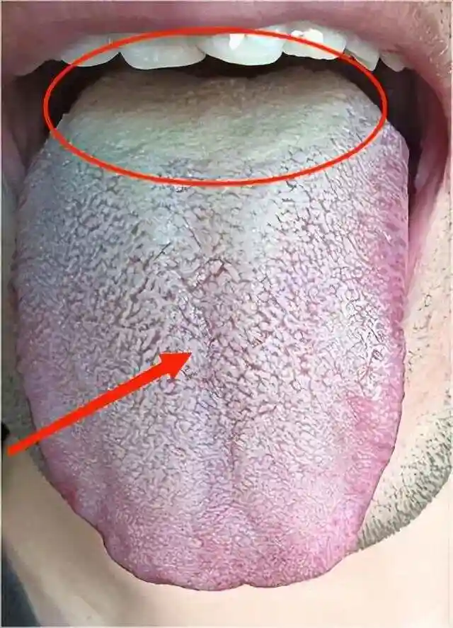 这种舌根厚腻苔,上来就用金匮肾气猛补阳,方向不对