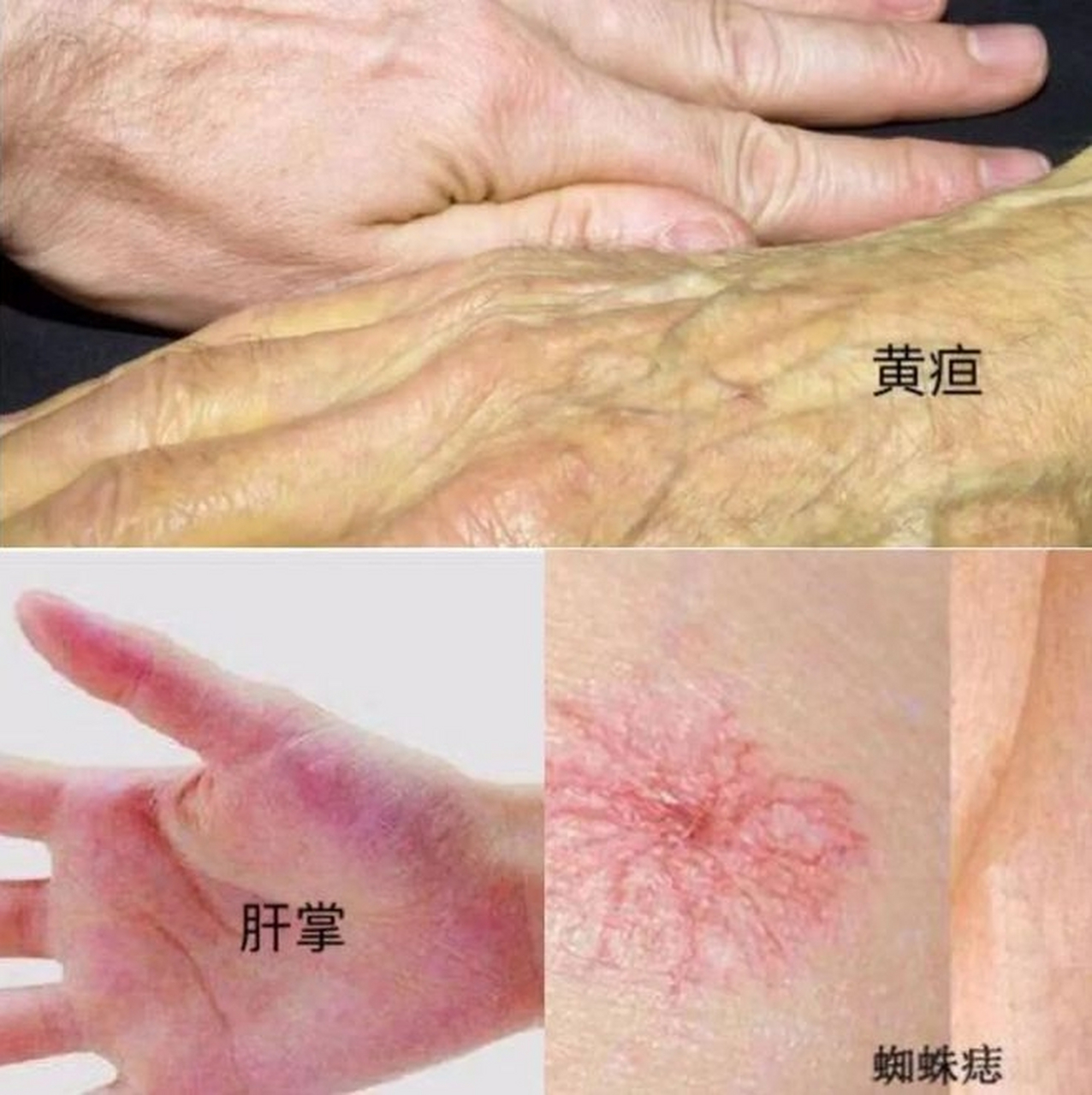 不要相信别人说的肝是哑巴器官肝癌早期没有症状.