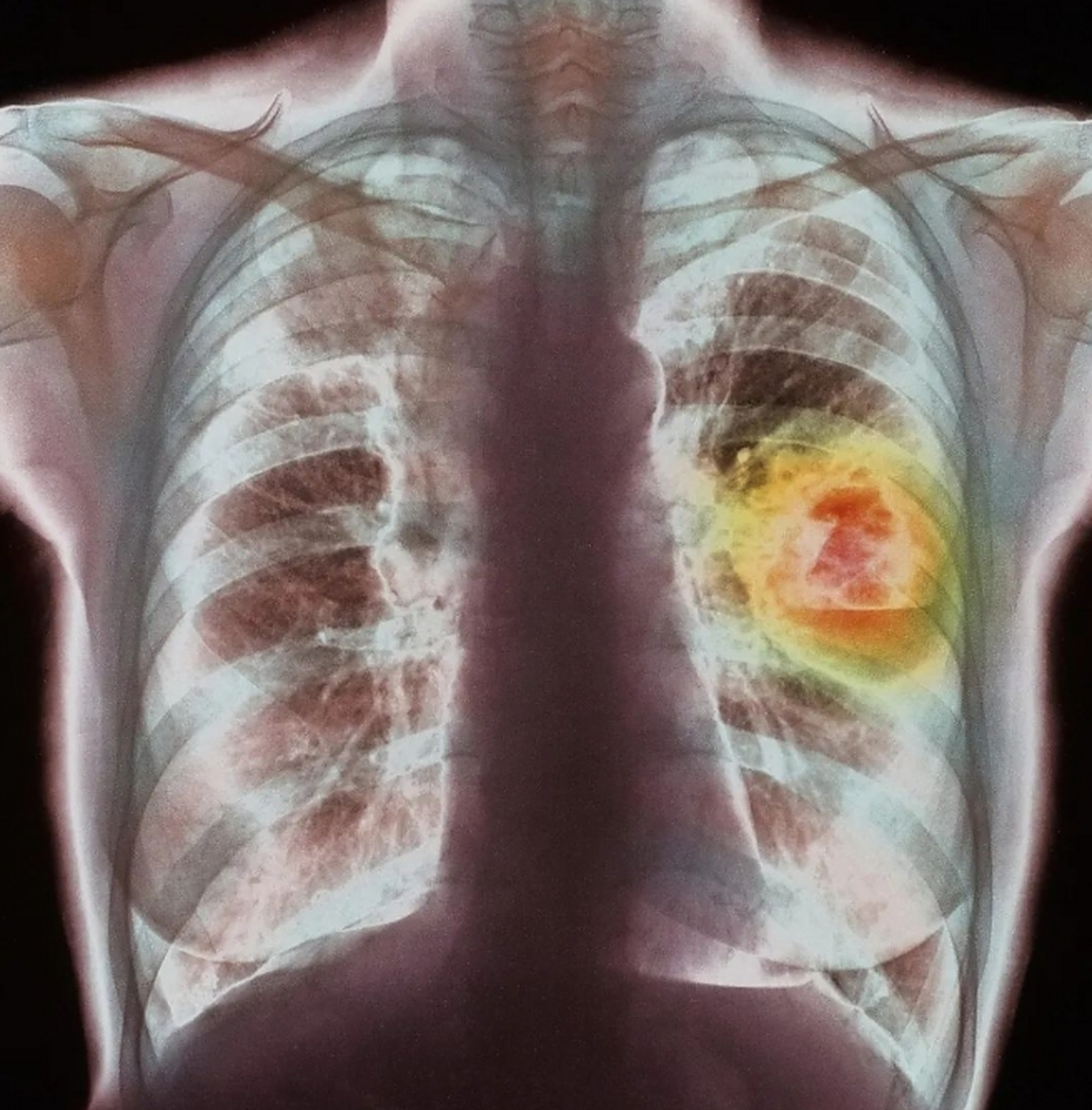 提醒,这8个常见表现,或为肺癌的早期"信号",请查下肺部ct!