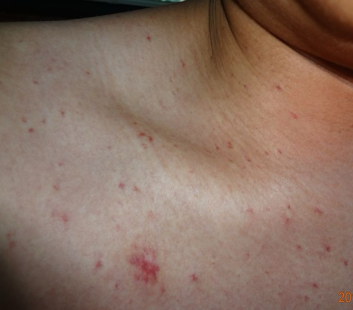 面部出现这个症状警惕肝癌!