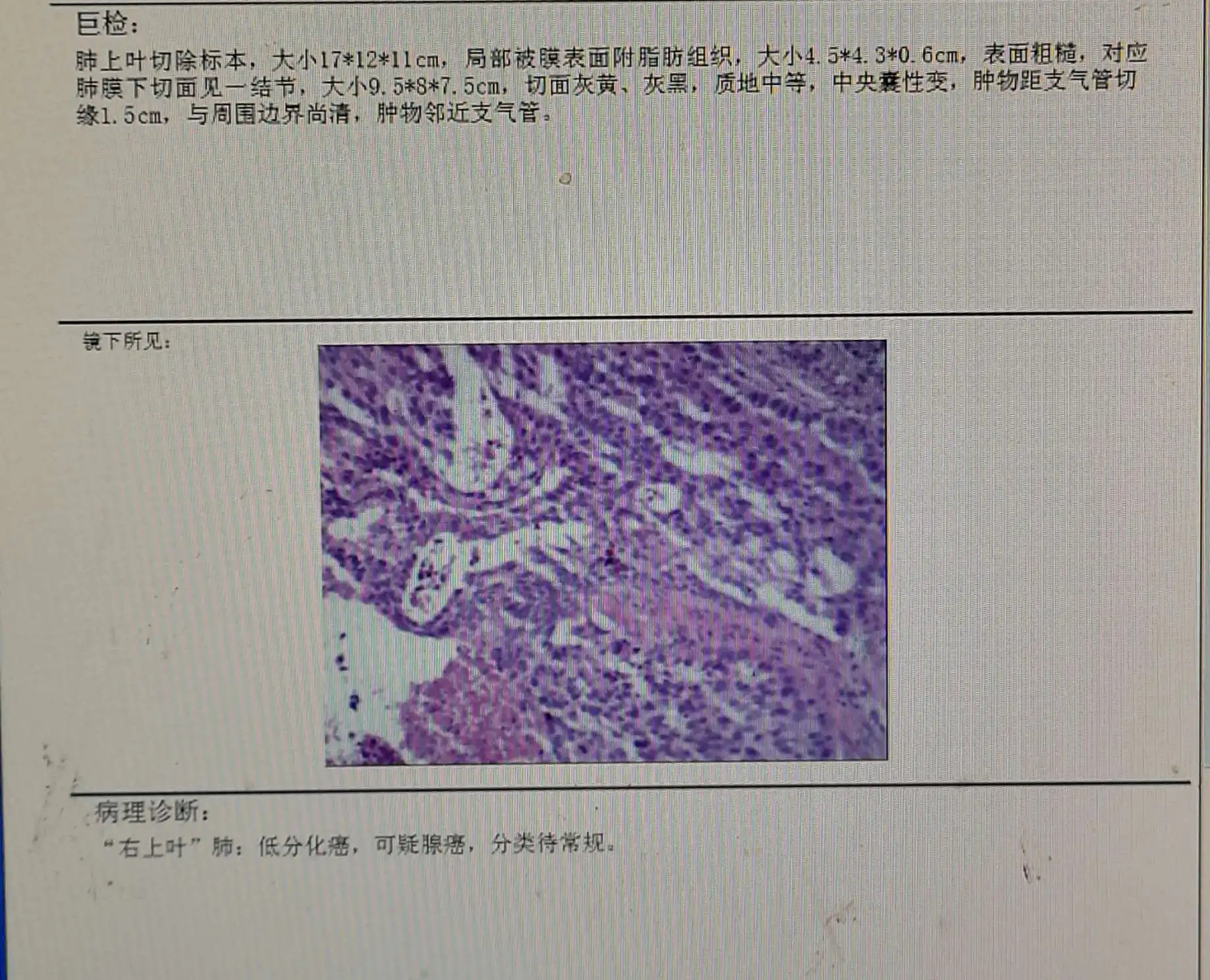 中分化肺鳞癌图片