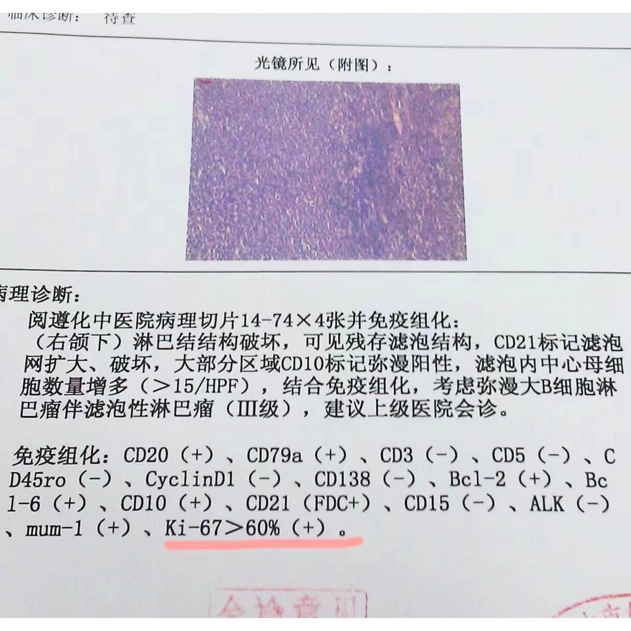 免疫组化报告图片图片