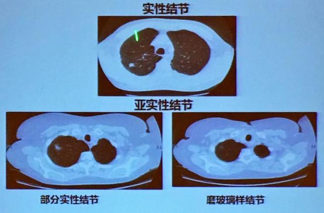 肺息肉图片