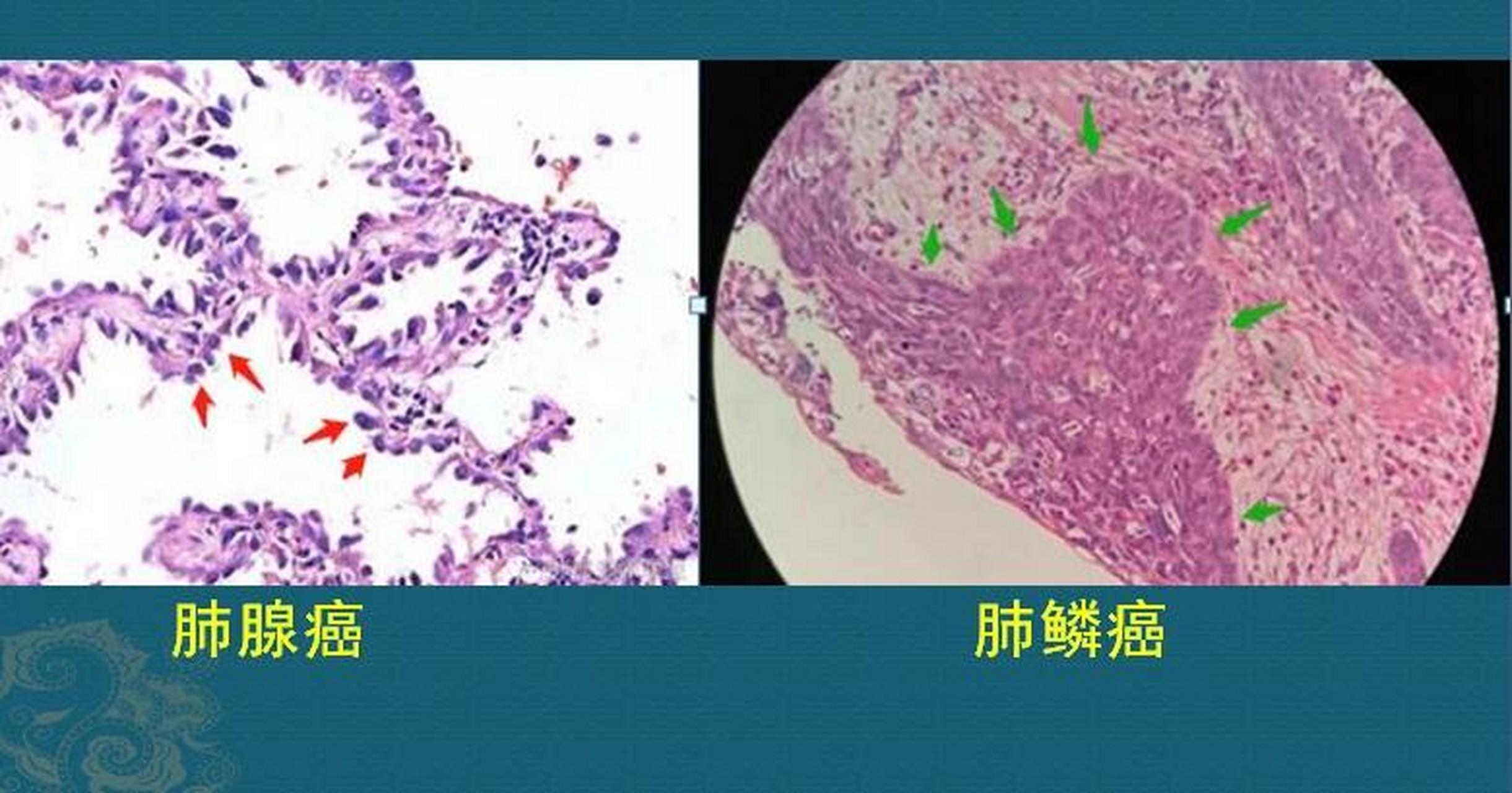 中分化肺鳞癌图片