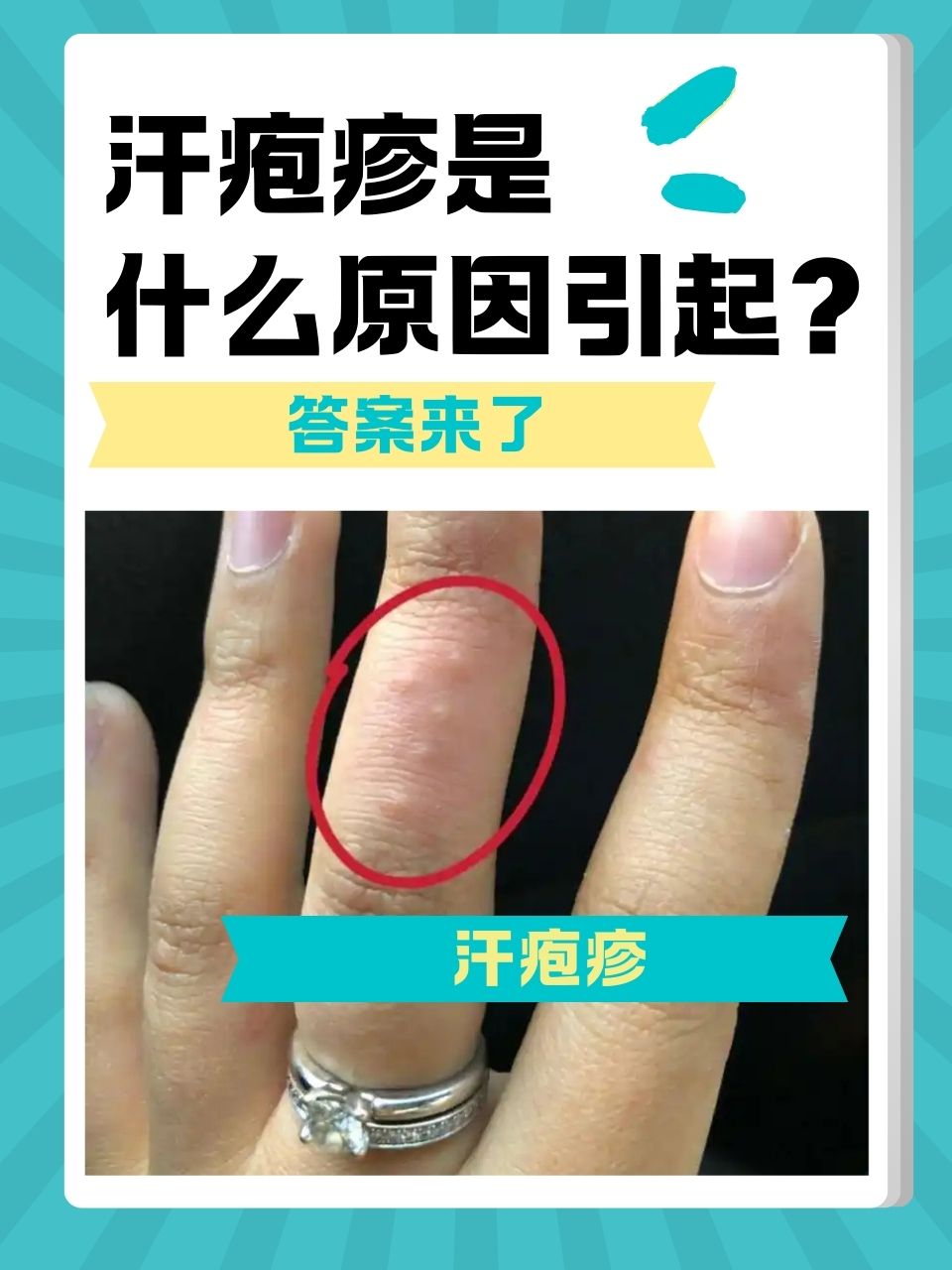 汗疱疹是一种好发于手掌,手指侧面,指端皮肤的复发性水疱性皮肤病