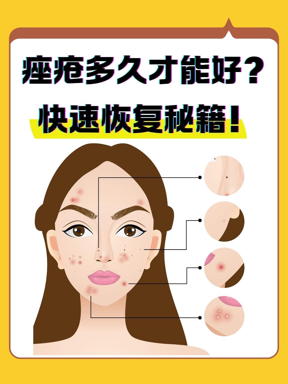 为什么会长痤疮的原因为什么在线 为什么会长痤疮的原因为什么在线