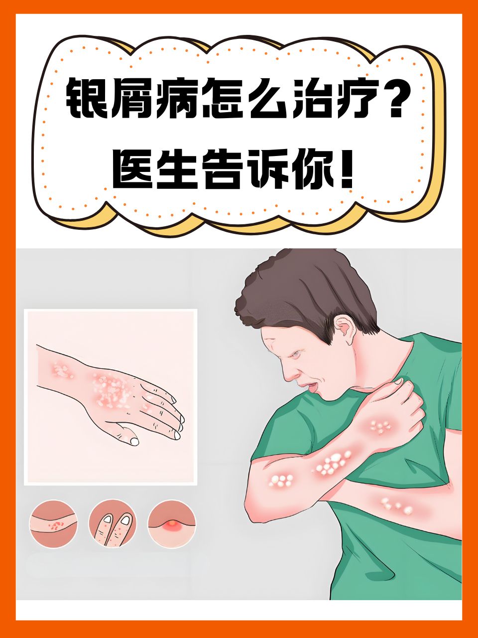 如何选择合适的银屑病医院：看银屑病哪家医院好？