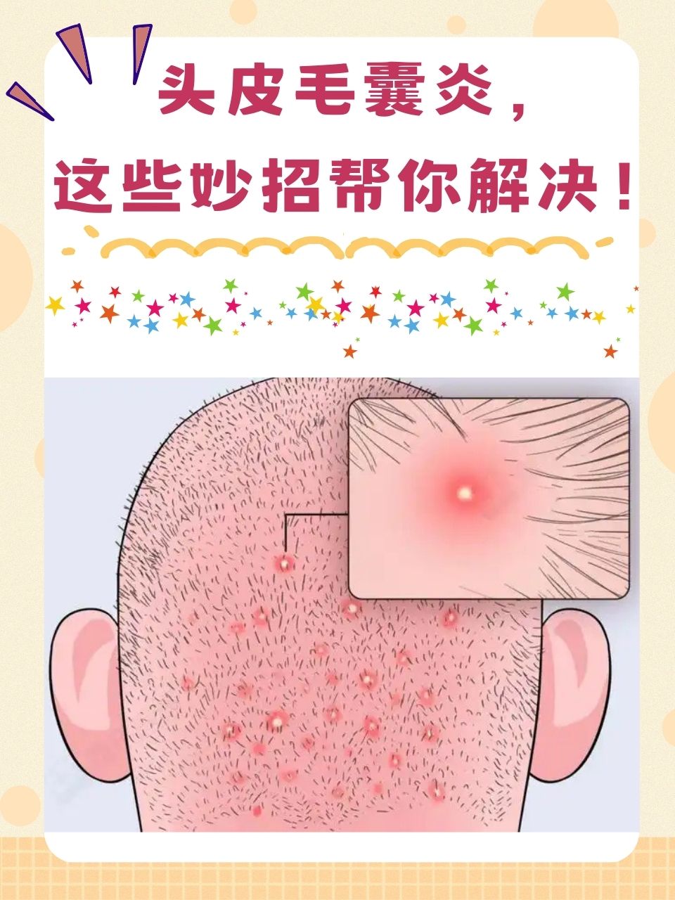头皮毛囊炎疙瘩的治疗方法通常有以下