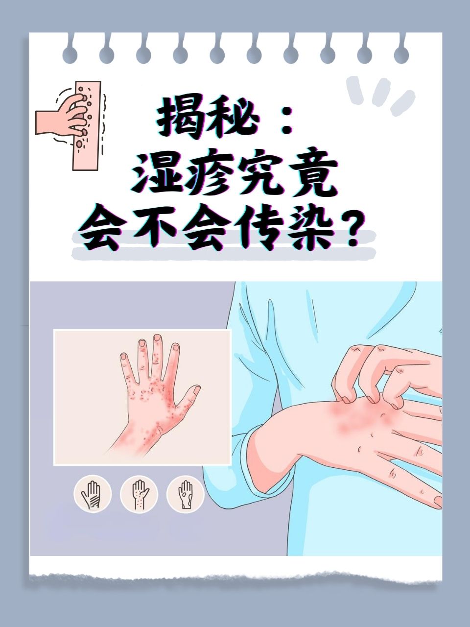 湿疹,这一常见的皮肤炎症性疾病,常常让患者陷入困扰