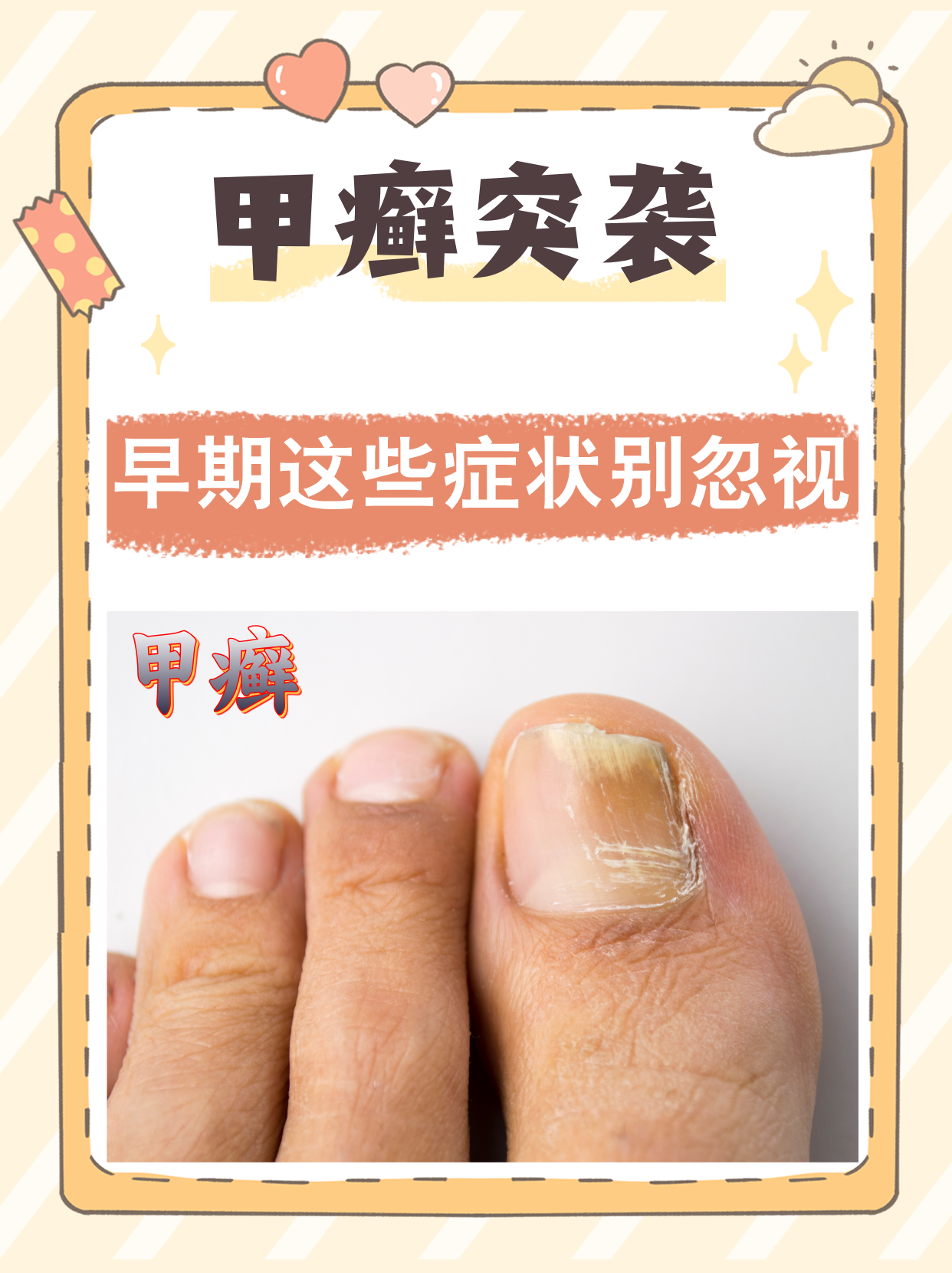 早期这些症状别忽视 甲癣是一种由真菌感染引起的指甲疾病,如果不及时