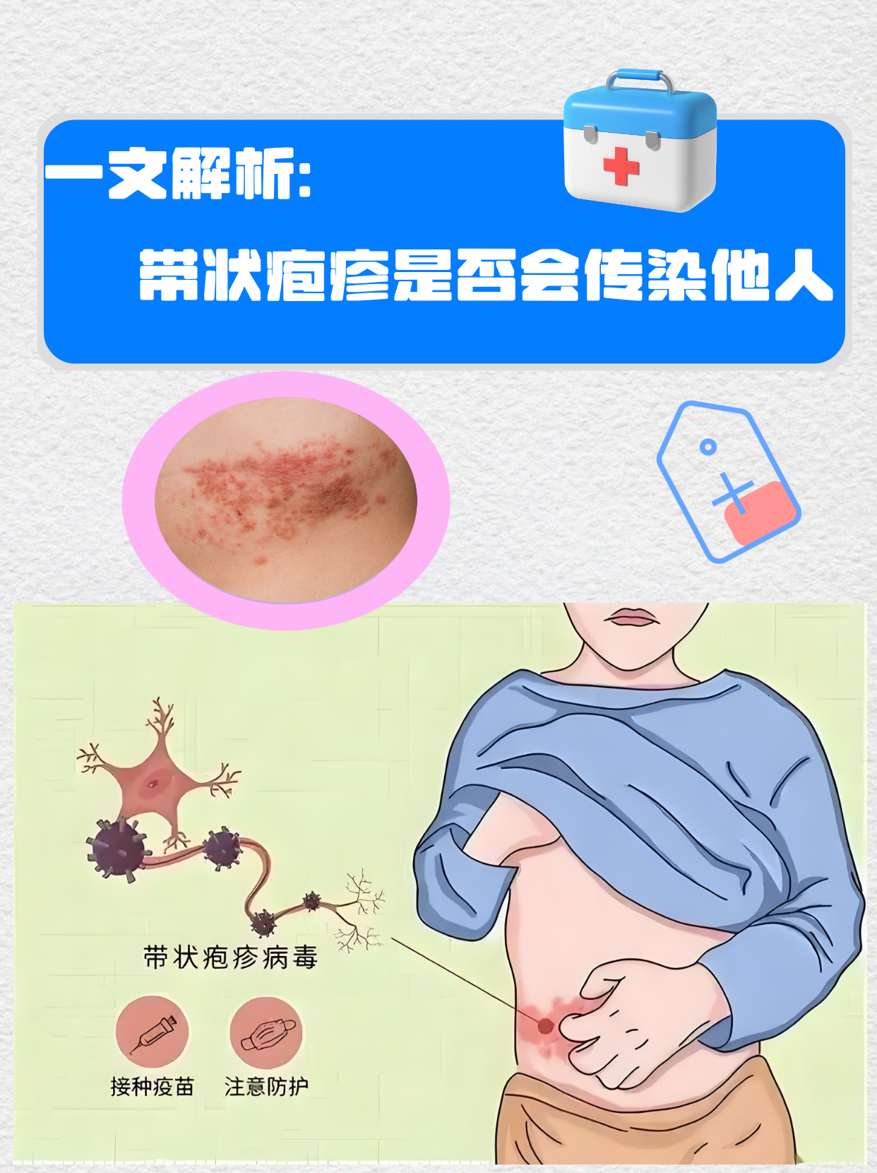 一文解析,带状疱疹是否会传染他人