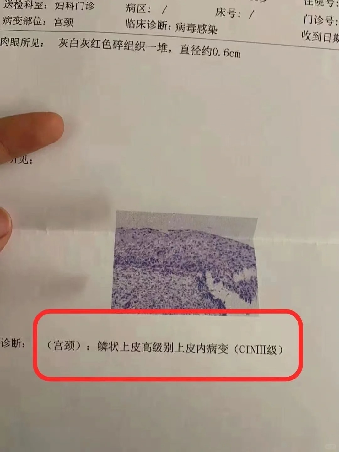 女hpv阳性看哪个科大夫
（女性查抄
出hpv阳性治疗要去看什么科）《女性检查出hpv阳性治疗要去看什么科》