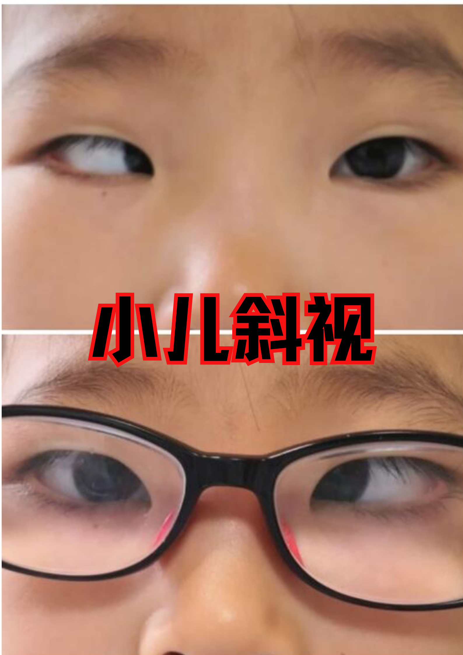 最近门诊来了个小朋友,斜视了,妈妈说是之前放假整天躺着玩手机闹的