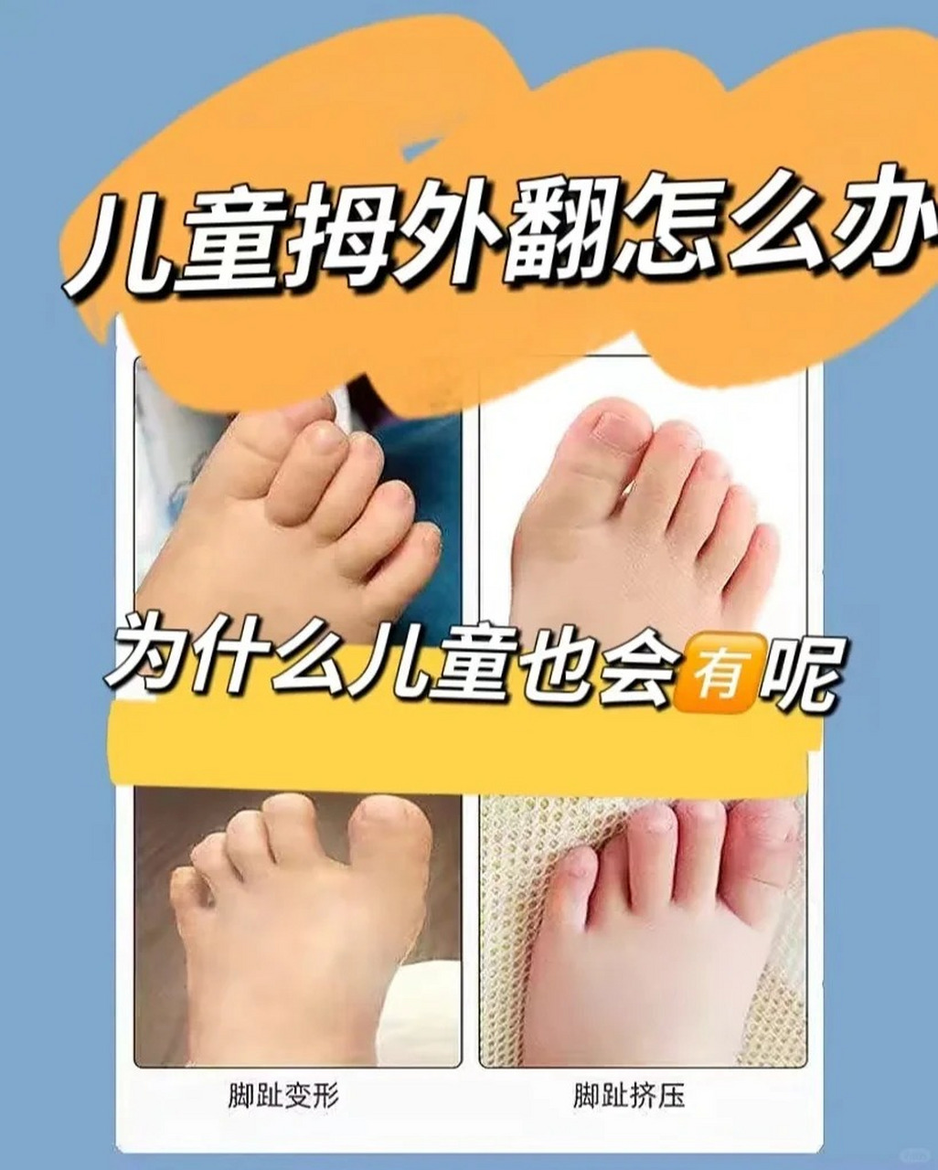 儿童为什么会有拇外翻?