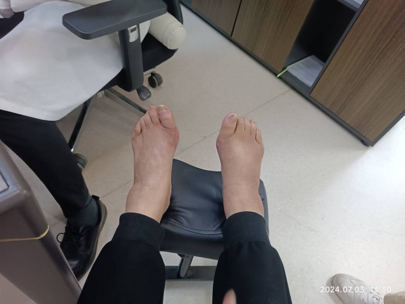 以下是一些可能引起拇外翻的原因:    1.