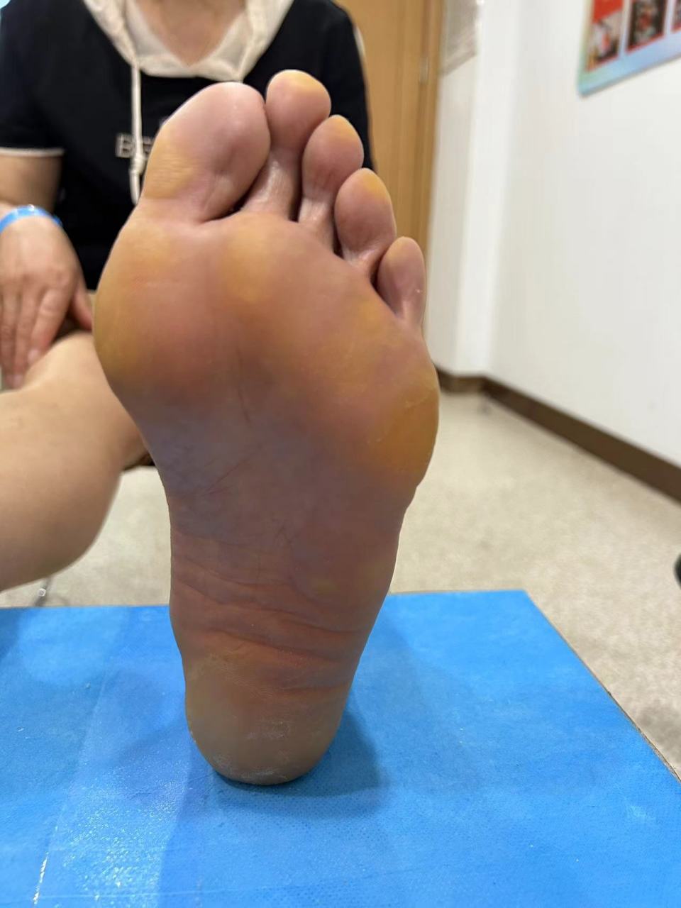 双脚遗传性拇外翻多年,脚底长满老茧,跖骨歪斜,走路疼痛#拇外翻# #拇