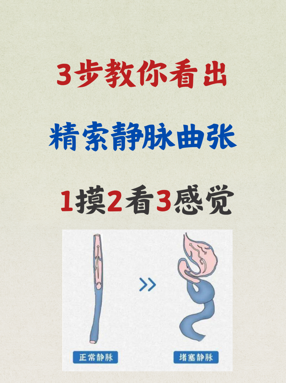 3步教你看出,精索静脉曲张!#精索静脉曲张# #中医男科# #男性健康
